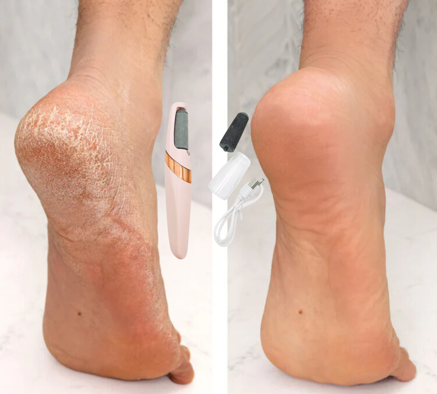 ¡Elimina esos molestos Callos!