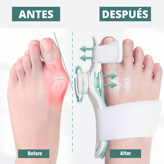 ¡Camina sin dolor y corrige tu juanete sin cirugía!