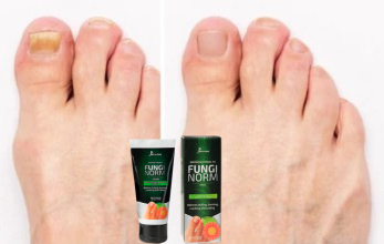 ¡Dile adiós al Hongo de tus Uñas!